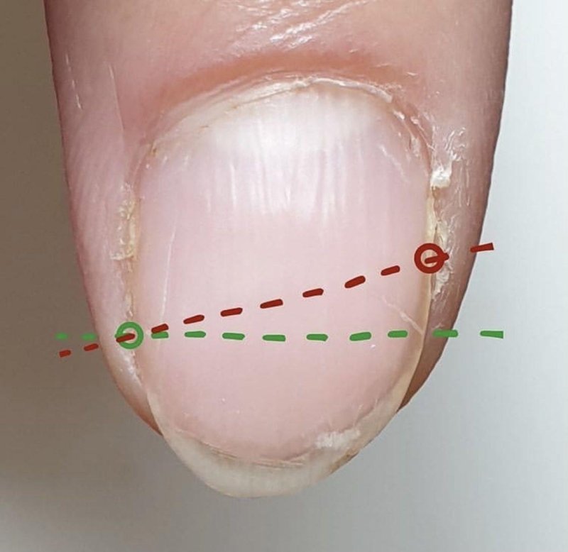 Продольные борозды на ногтях