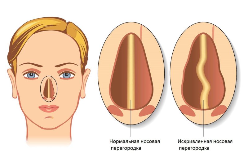 Искривлена носовая перегородка
